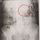 Imagen para el artículo titulado Esta mujer soñó que se había tragado su anillo de compromiso. Cuando despertó ya no lo tenía